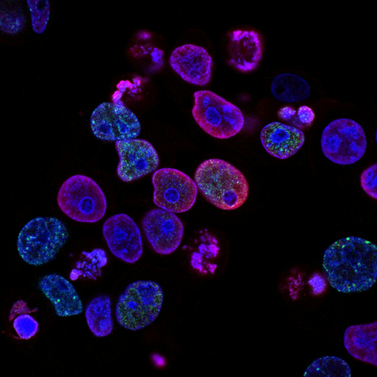 IVF vs ICSI: Which is right for your case?